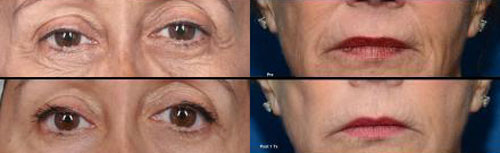 ThermiSmooth for eyes and mouth wrinkles