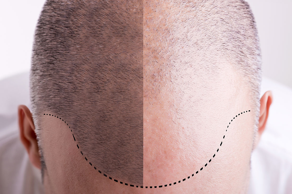 PRP Hair Restoration Before After