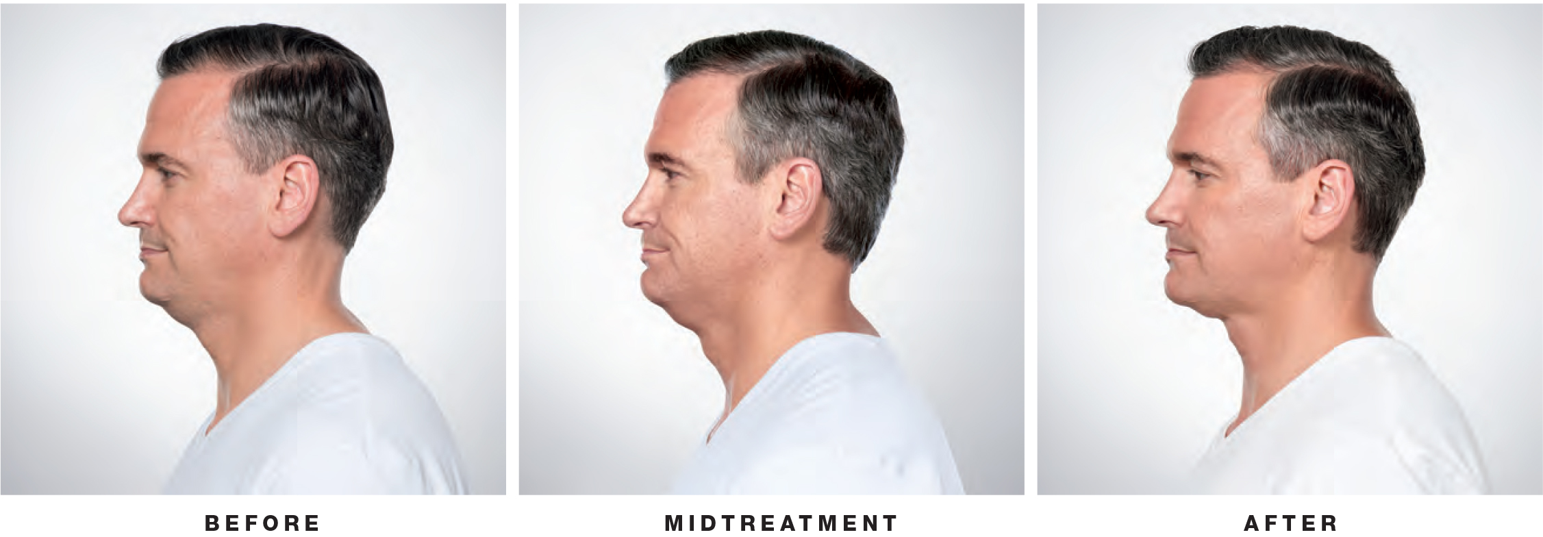 Kybella on Man Before Midtreatment After