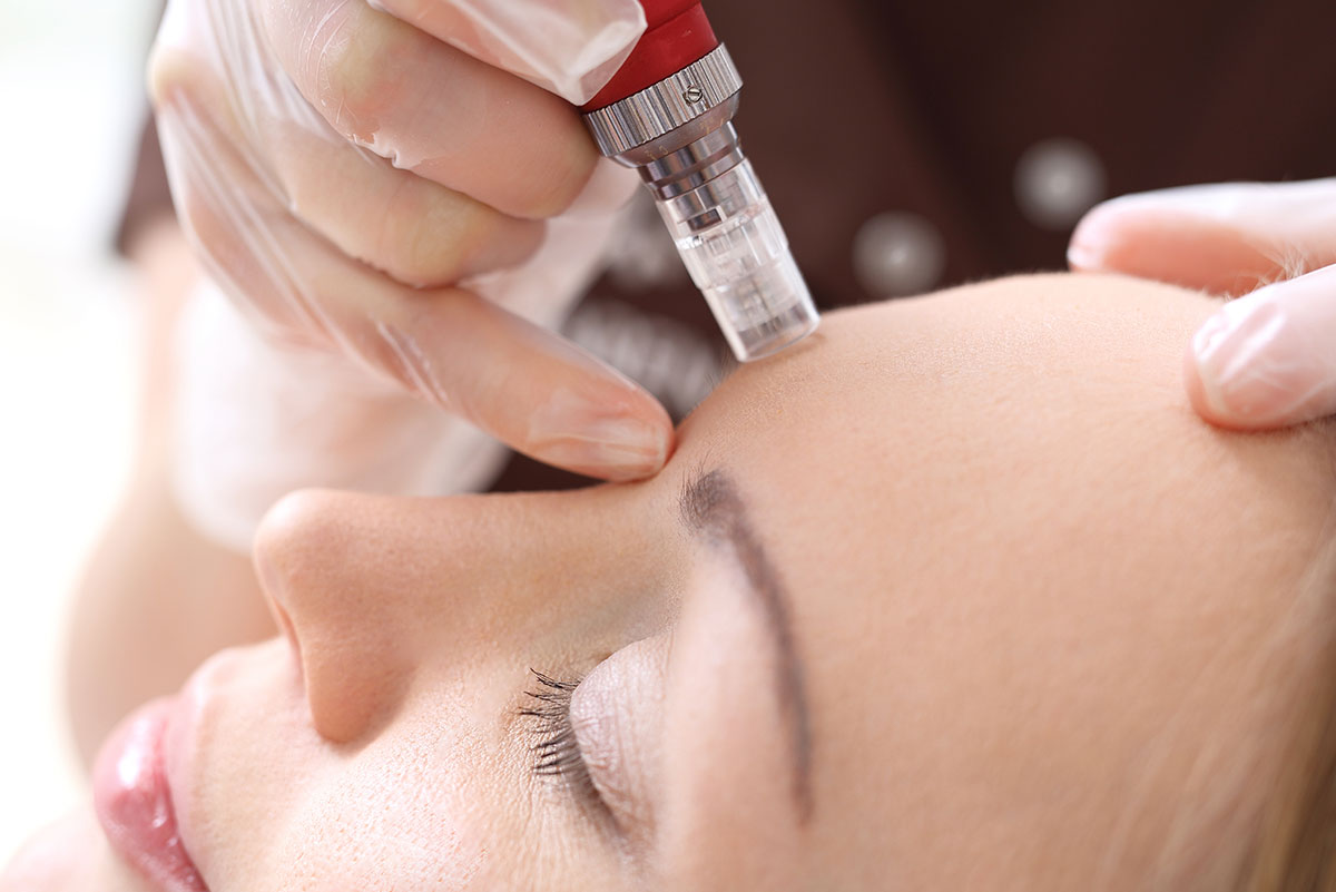 PRP Microneedling