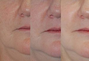 Photofacial for Spider Veins Before After
