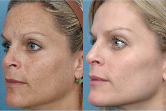 Ipl foto facial