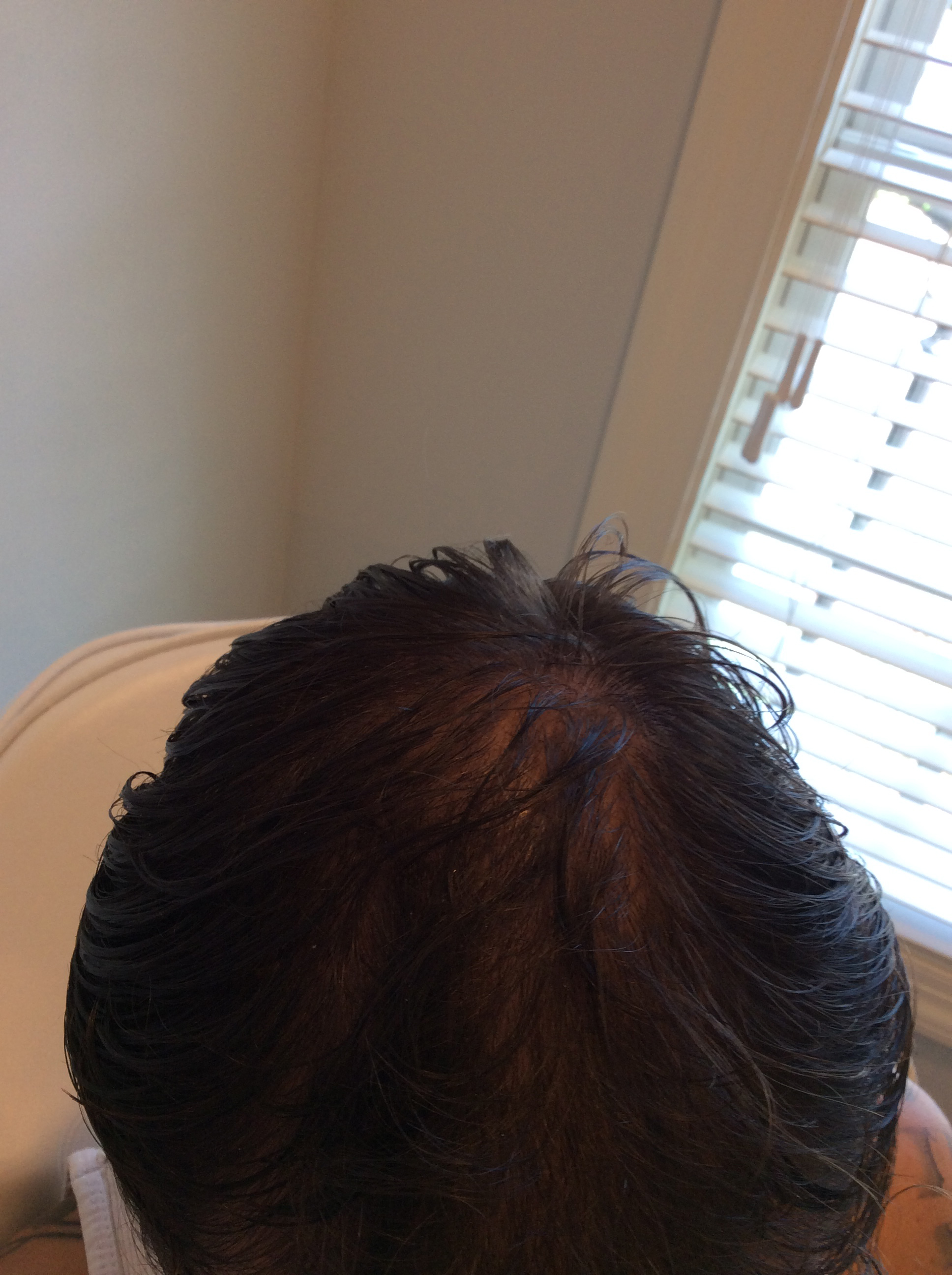 PRP Hair Restoration Final Results