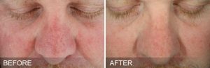 Hydrafacial for Sun Damage Before After