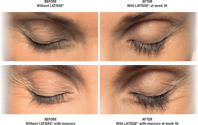 Latisse Before After With and Without Mascara
