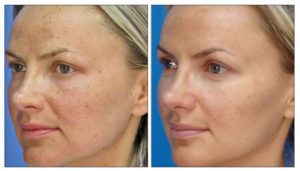 Photofacial Before and After on Woman
