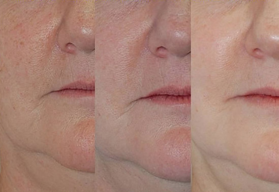 Photofacial for Spider Veins Before After